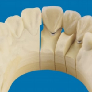 Metal-dentes de porcelana