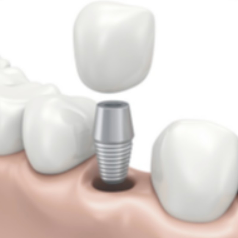 implante dentário